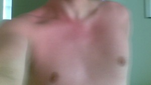 My burned body